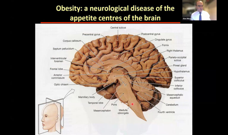 Diagram of a brain cross-section labeled with parts and functions, titled "Obesity: a neurological disease of the appetite centres of the brain," with a speaker in the corner.