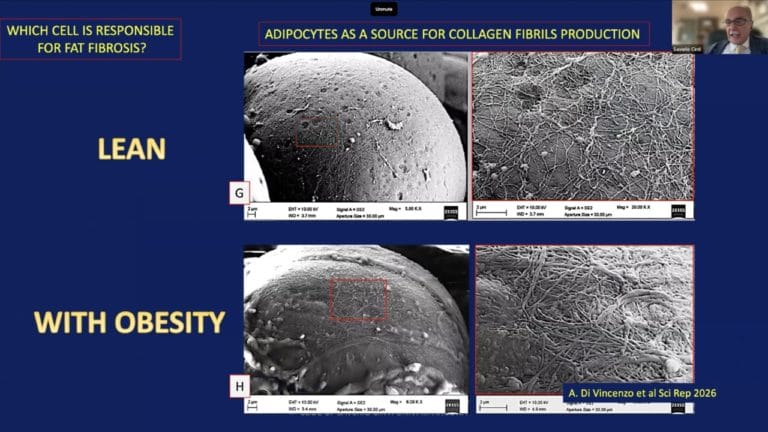 Scanning electron microscope images comparing adipocytes from lean versus obese tissue, showing collagen fibril production.